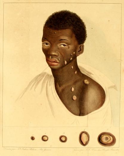 image of an Afro-Brazilian man with skin pustules